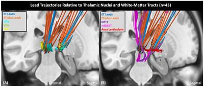 Deep brain stimulation for essential tremor versus essential tremor plus: should we target the same spot in the thalamus?
